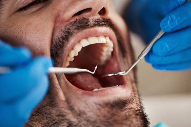 Best Emergency Wisdom Teeth Removal in Walls, MS